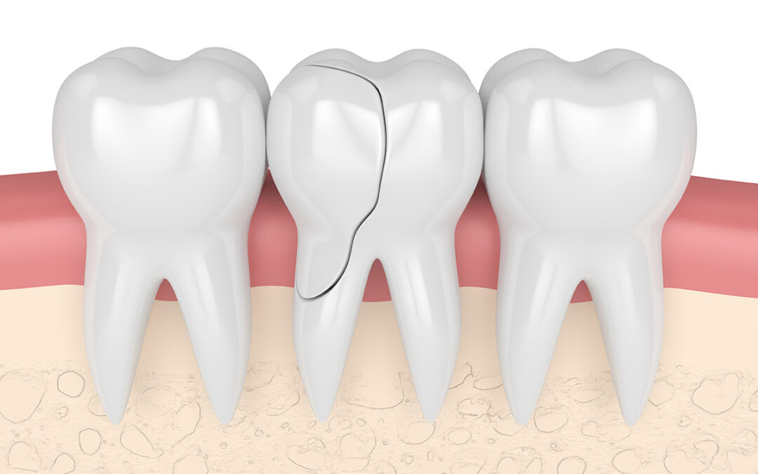 Pull It or Save It—What Should You Do with a Damaged Tooth?