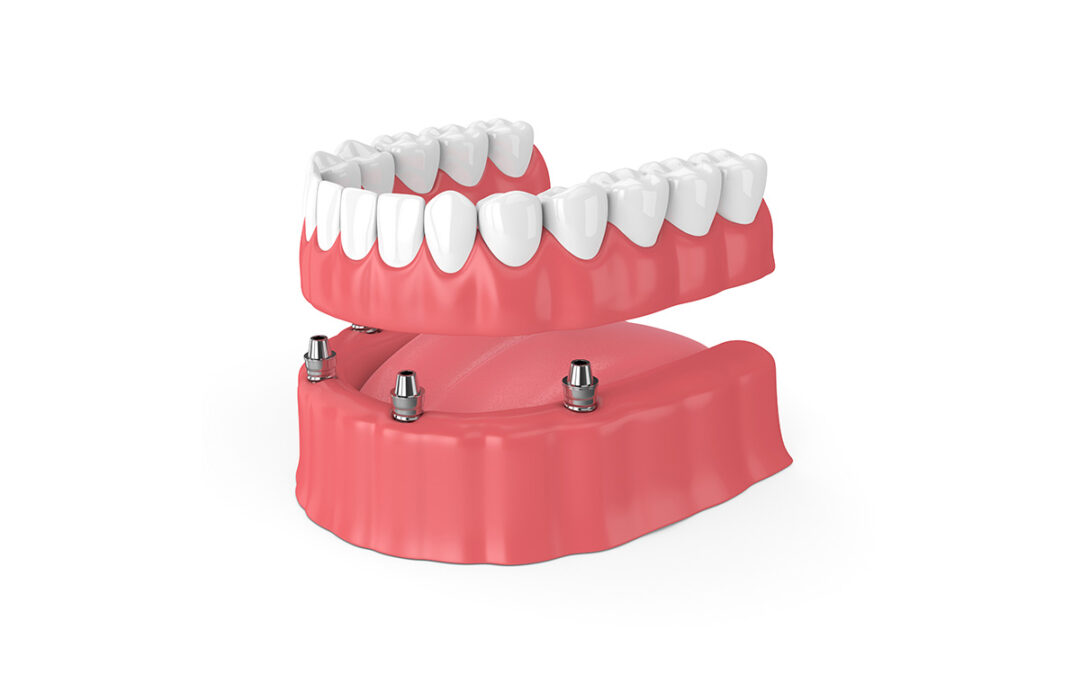 What Are the Advantages of Implant-Supported Dentures?