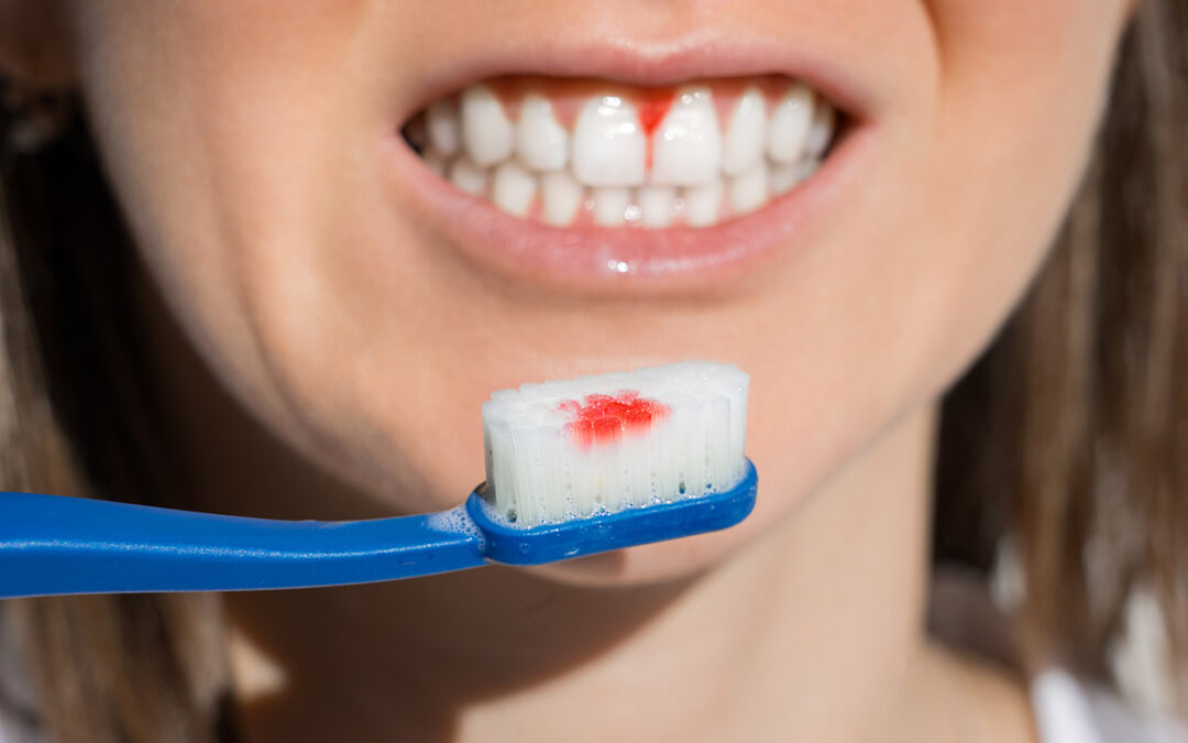 What Are the Stages of Gum Disease?