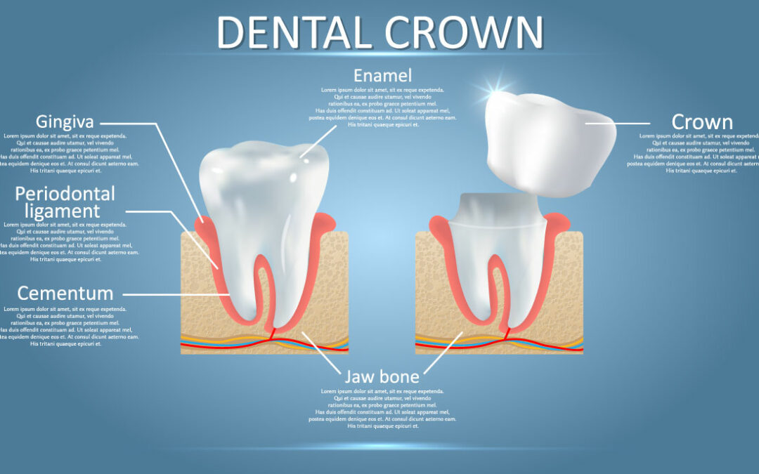 5 Benefits of a Dental Crown