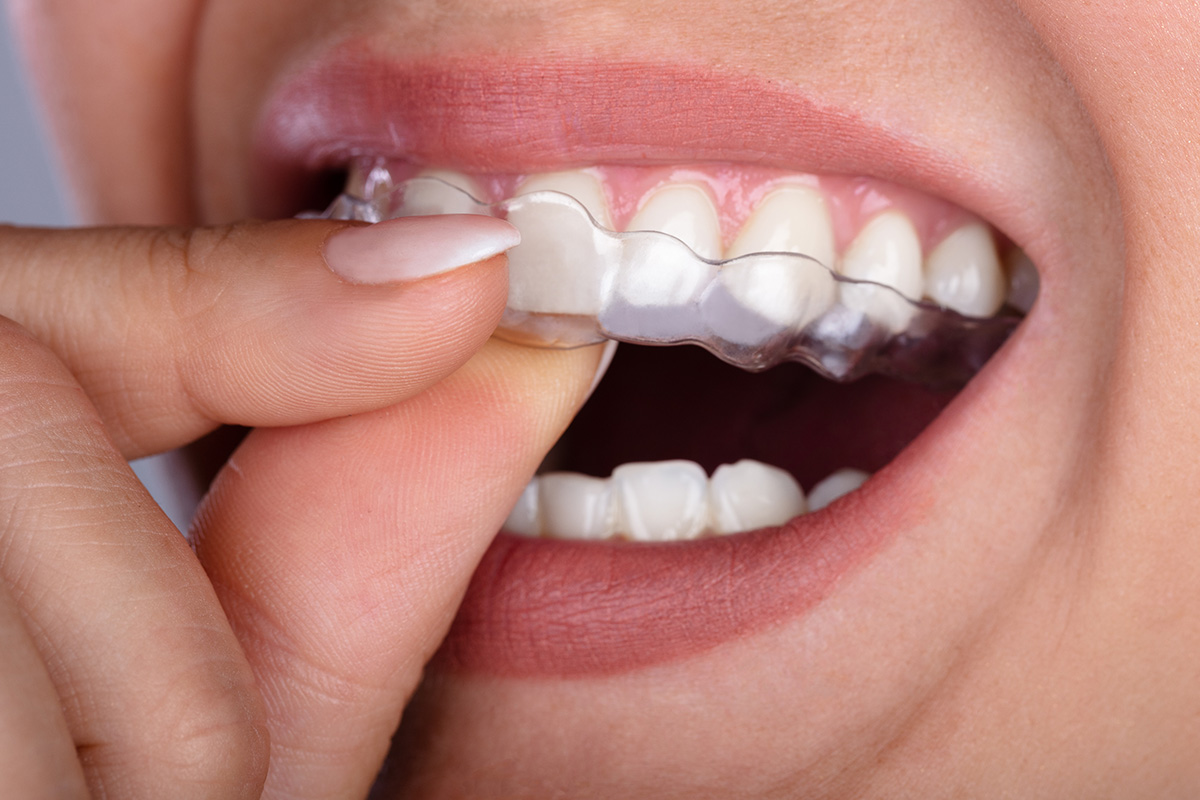 Get Clear Aligners in Clarksville