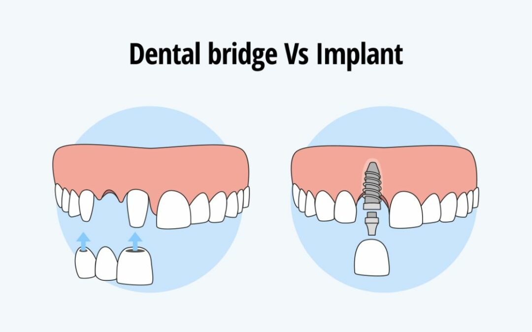 Dental Bridges or Implants